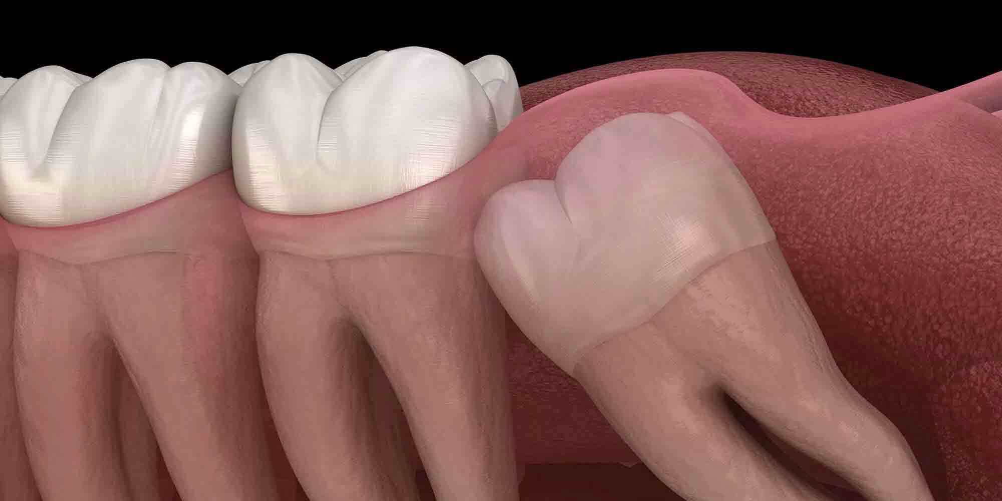Understanding Wisdom Teeth: When and Why They Need Removal